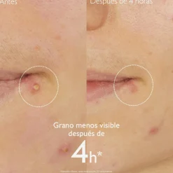 Stop Granos con Acido Salicílico