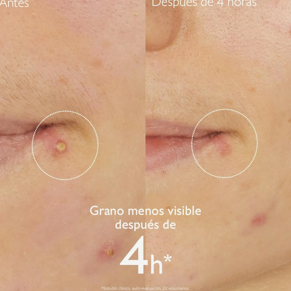 Stop Granos con Acido Salicílico
